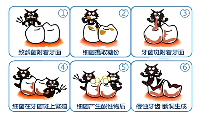 儿童乳牙龋坏怎么办？家长看这篇就够了