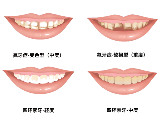 叮~这里有一份牙齿美白的秘诀送给爱笑的你！