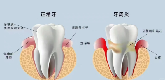 牙龈炎是怎么回事？一篇文章全读懂