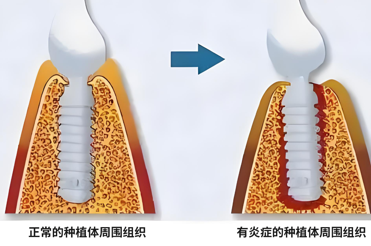 种牙后为什么要按时复诊？答案在这里