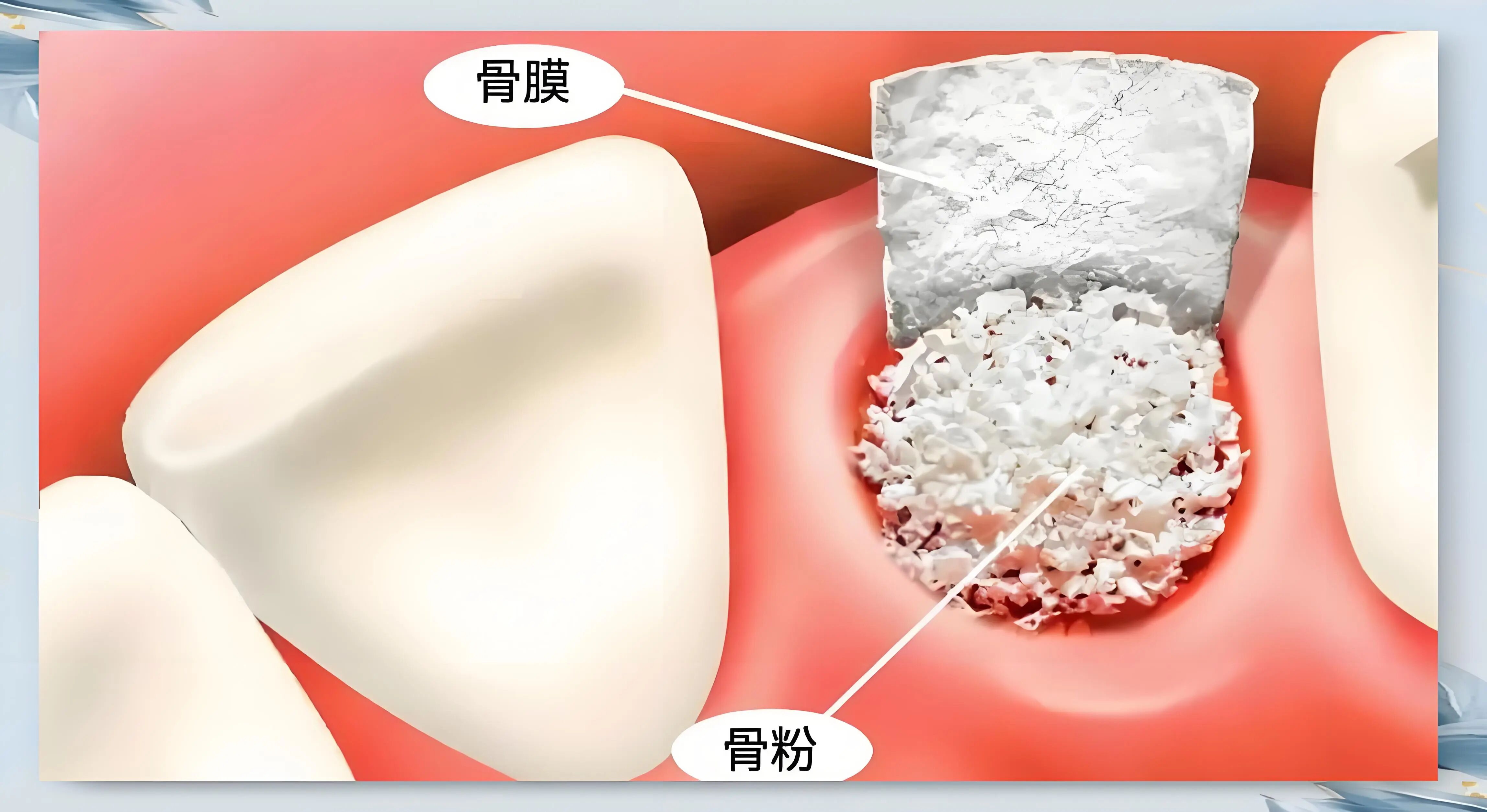 种植牙一定要加骨粉吗？一篇全看懂